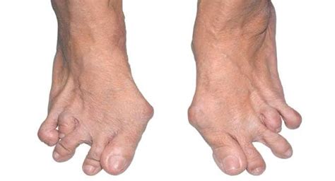 How rheumatoid arthritis affects the foot and ankle | TheHealthSite.com