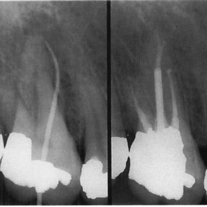 Apical periodontitis and endodontic treatment. Pre-operative ...