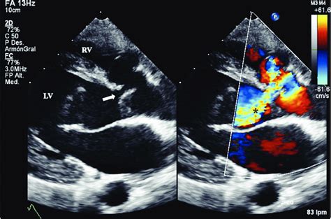 Transthoracic echocardiogram shows the ventricular septal defect ...