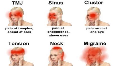 headache-types-1 - BBN Community