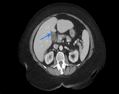 Cureus | Inferior Vena Cava Calcified Thrombus Presenting With ...