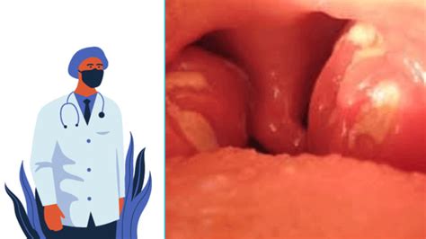 Best Treatment of Infectious Mononucleosis - Doctor's View