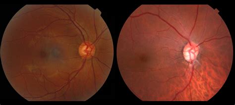 What is Glaucoma? — Wollongong Eye Doctor | Ophthalmologist Dr Steven ...