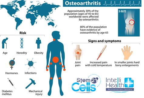 rheumatoid arthritis treatment | Adult Stem Cell Therapy Abroad, Stem ...