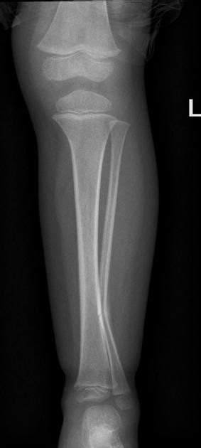 Greenstick Fracture X Ray