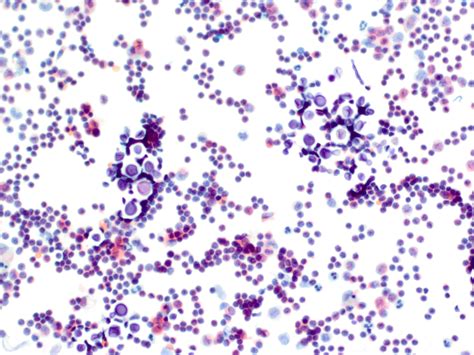 Pathology Outlines - Fungal infections (pending)