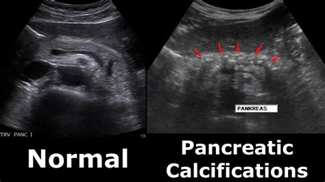 Pancreas Ultrasound Normal Vs Abnormal Appearances Comparison Pancreas ...