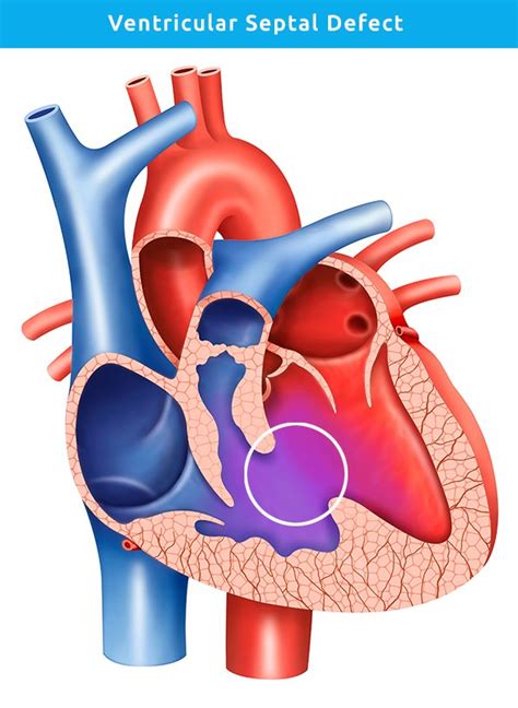 Ventricular Septal Defect