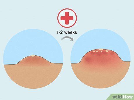 How To Treat Vaginal Boils