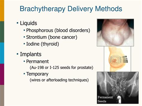 PPT - Introduction to Brachytherapy PowerPoint Presentation, free ...