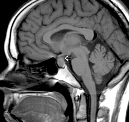 CT/MRI: Prolactinoma