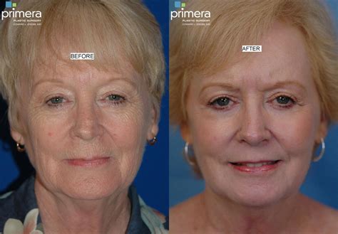 Chemical Peel for Orlando & Winter Park, FL | Primera Plastic Surgery