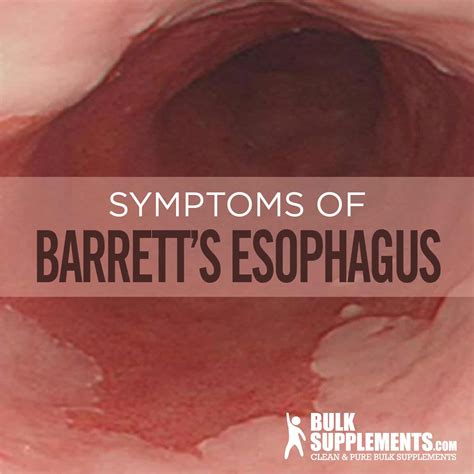 Barrett's Esophagus: Symptoms, Causes & Treatment