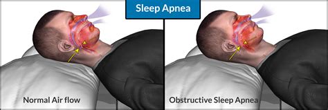 Obstructive Sleep Apnoea Treatment In Pune & PCMC | Mild Sleep Apnea ...