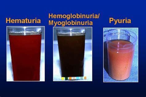 44 best Blood In Urine (Hematuria) images on Pinterest | Abdominal ...