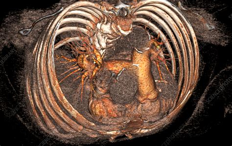 Pulmonary artery, CT scan - Stock Image - C057/7895 - Science Photo Library