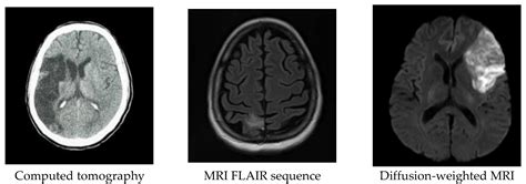 Intracerebral Hemorrhage Mri