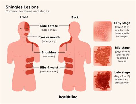 Shingles Lesions: Pictures, Location, Duration, and Treatment