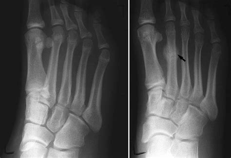 Metatarsal Stress Fracture