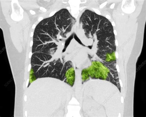 Lungs with vaping damage, baseline CT - Stock Image - C050/4472 ...