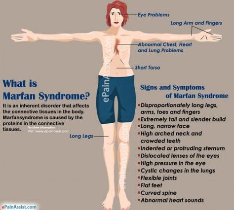 What is Marfan Syndrome? #medical #medical #facts in 2020 | Marfan ...