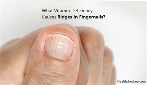 What Vitamins Deficiency Causes Ridges In Fingernails | Fingernails ...