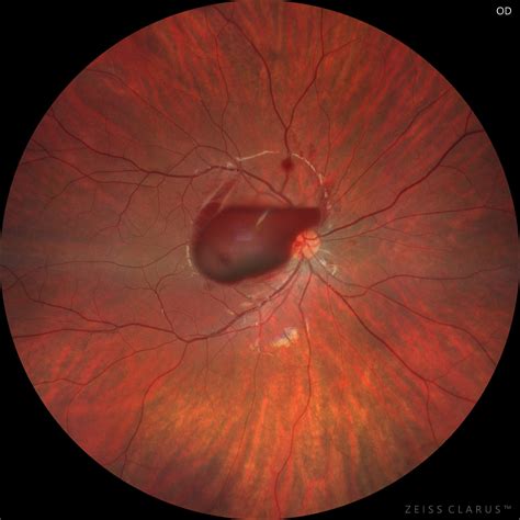 VALSALVA-RETINOPATHY - Southeastern Retina Associates