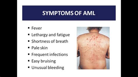 Case study: Acute Myeloid Leukemia - YouTube