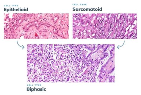 Biphasic Mesothelioma | Cell Type Prognosis & Treatment