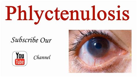 Phlyctenulosis Introduction, Clinical features, signs, symptoms and ...