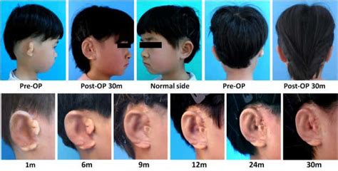 Children get new ears grown from their own cells in world first | New ...