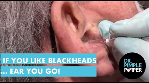 Dr Pimple Popper Blackheads On Ears 2021