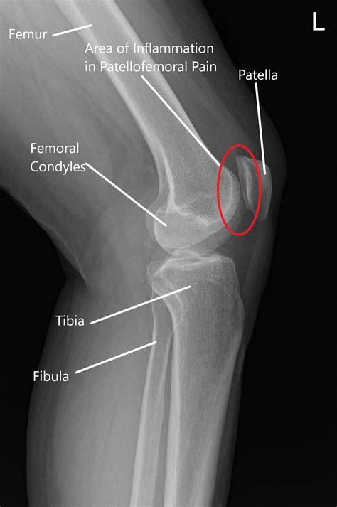 Patellofemoral Syndrome X Ray