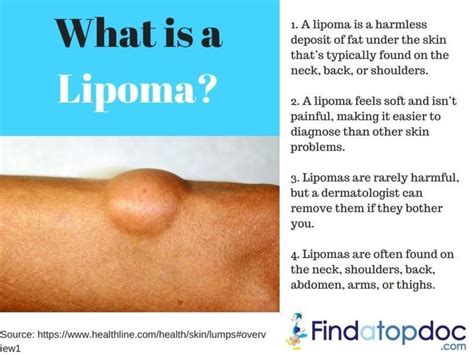 What is a Lipoma :Symptoms and Risk Factors [Infographic]