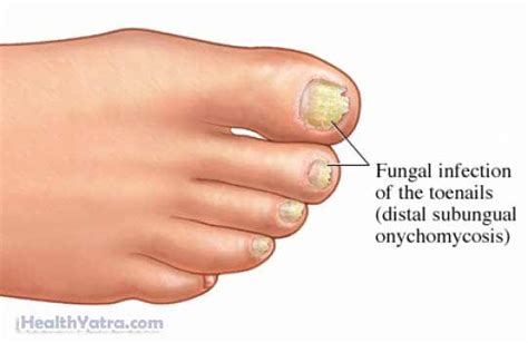 Onychomycosis Definition, Causes, Symptoms and Treatment Cost in India