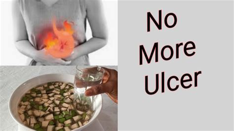 Ulcer Cure! Get Rid of Ulcer Permanently & Naturally - YouTube