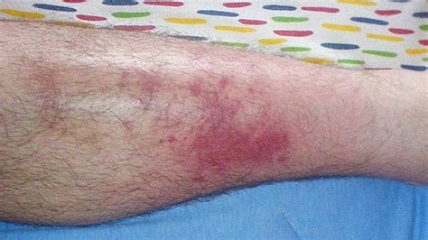 Cellulitis Knee