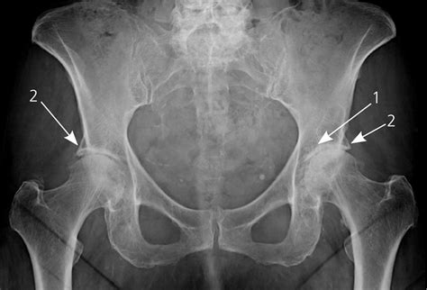 Degenerative Joint Disease - Causes & Treatment