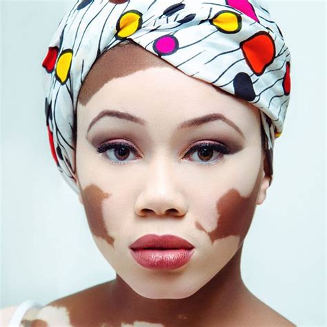 #Longliveslocs #headwraps #queen #wrappitup #turban | Vitiligo ...