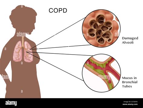 Illustration of chronic obstructive pulmonary disease (COPD), a common ...