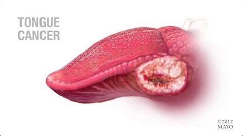 Squamous Cell Carcinoma Tongue Symptoms