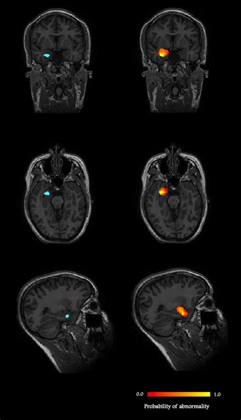 - An MRI positive case: a 27-year-old female patient, with right ...