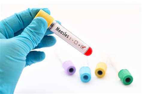 Measles Outbreak Updates - Health Beat