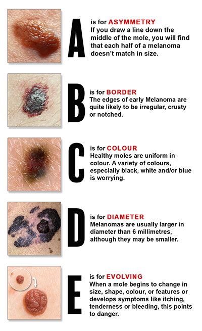 Melanoma Symptoms ABCDE: Detecting Skin Cancer Early - Doctor Heck