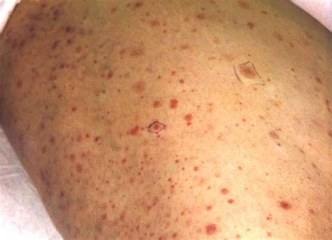 Petechiae definition, petechial rash causes, diagnosis & treatment