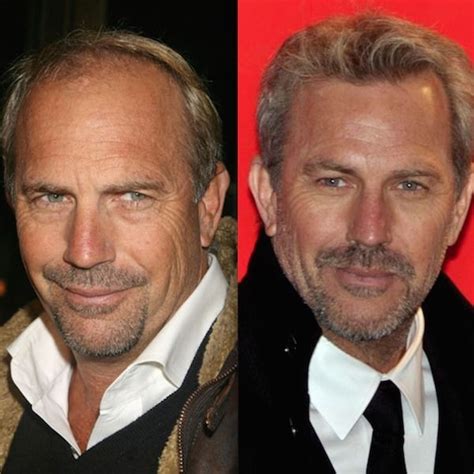 Kevin Costner’s Hair Transplantation from Disaster to Wonder