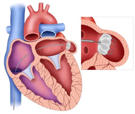 Left Atrial Appendage Occlusion - Dr Diana Holdright