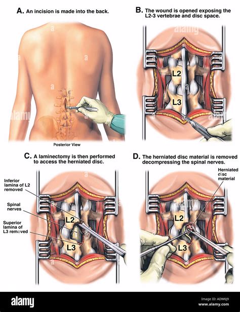 L2 l3 laminectomy hi-res stock photography and images - Alamy