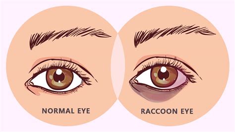 Raccoon Eyes Condition - Its Symptoms, Causes, Complications and More