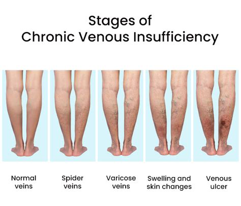 Venous Insufficiency Treatments in Brooklyn, New York - Vascular Specialist